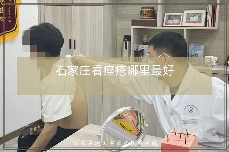 石家庄看痤疮哪里最好
