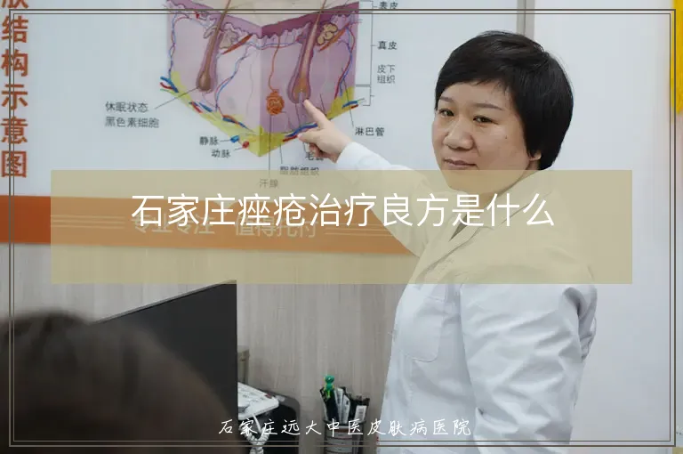 石家庄痤疮治疗良方是什么