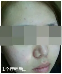 治疗后