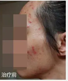 治疗前