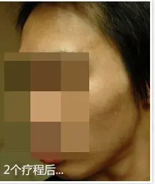 治疗后