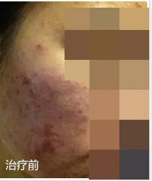 治疗前
