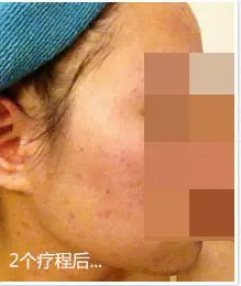 治疗后