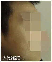 治疗后