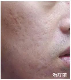 治疗前
