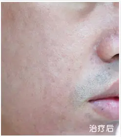治疗后