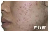治疗前