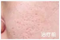 治疗后