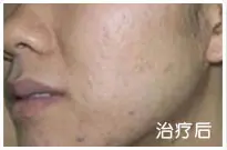治疗前