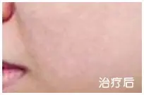 治疗后