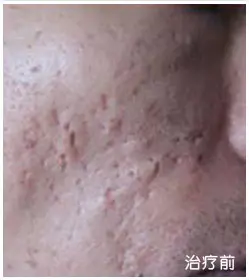 治疗前