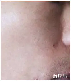 治疗后