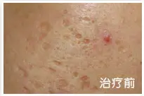 治疗前