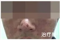 治疗后