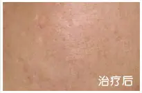 治疗前