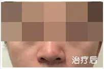 治疗后