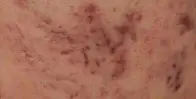 黑色痘印