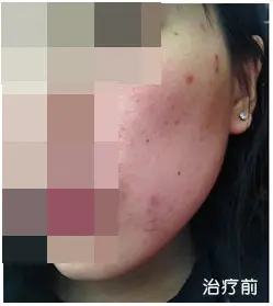 治疗前