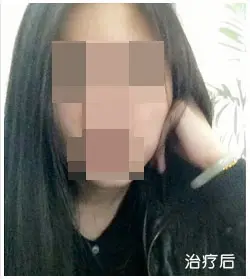 治疗后