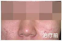治疗前