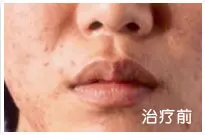 治疗后