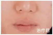 治疗后
