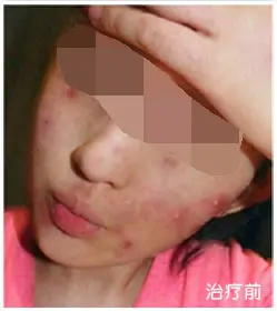 治疗前