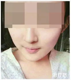 治疗后