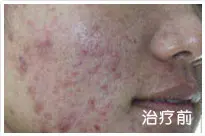 治疗前