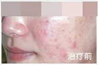 治疗后