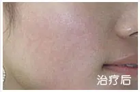治疗前