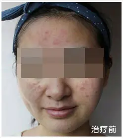 治疗前