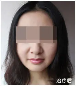 治疗后