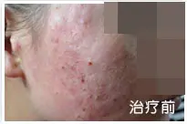 治疗前