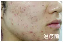 治疗后