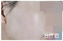 治疗前