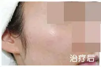 治疗后