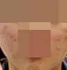 青春痘