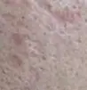 痘坑