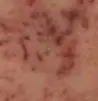 痘印