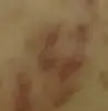 痘疤