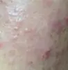 红肿疙瘩