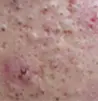 黑头粉刺