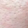 毛孔粗大